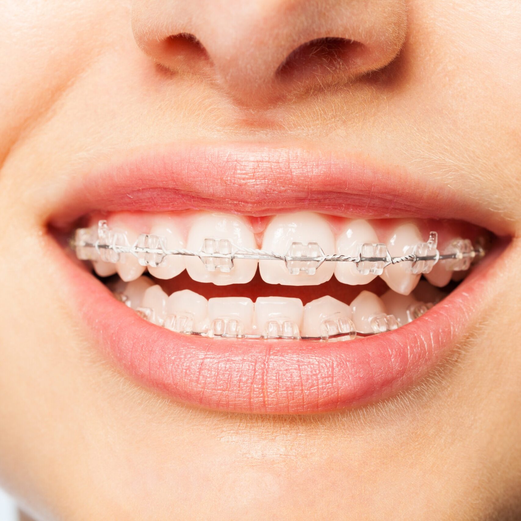 Clear Braces